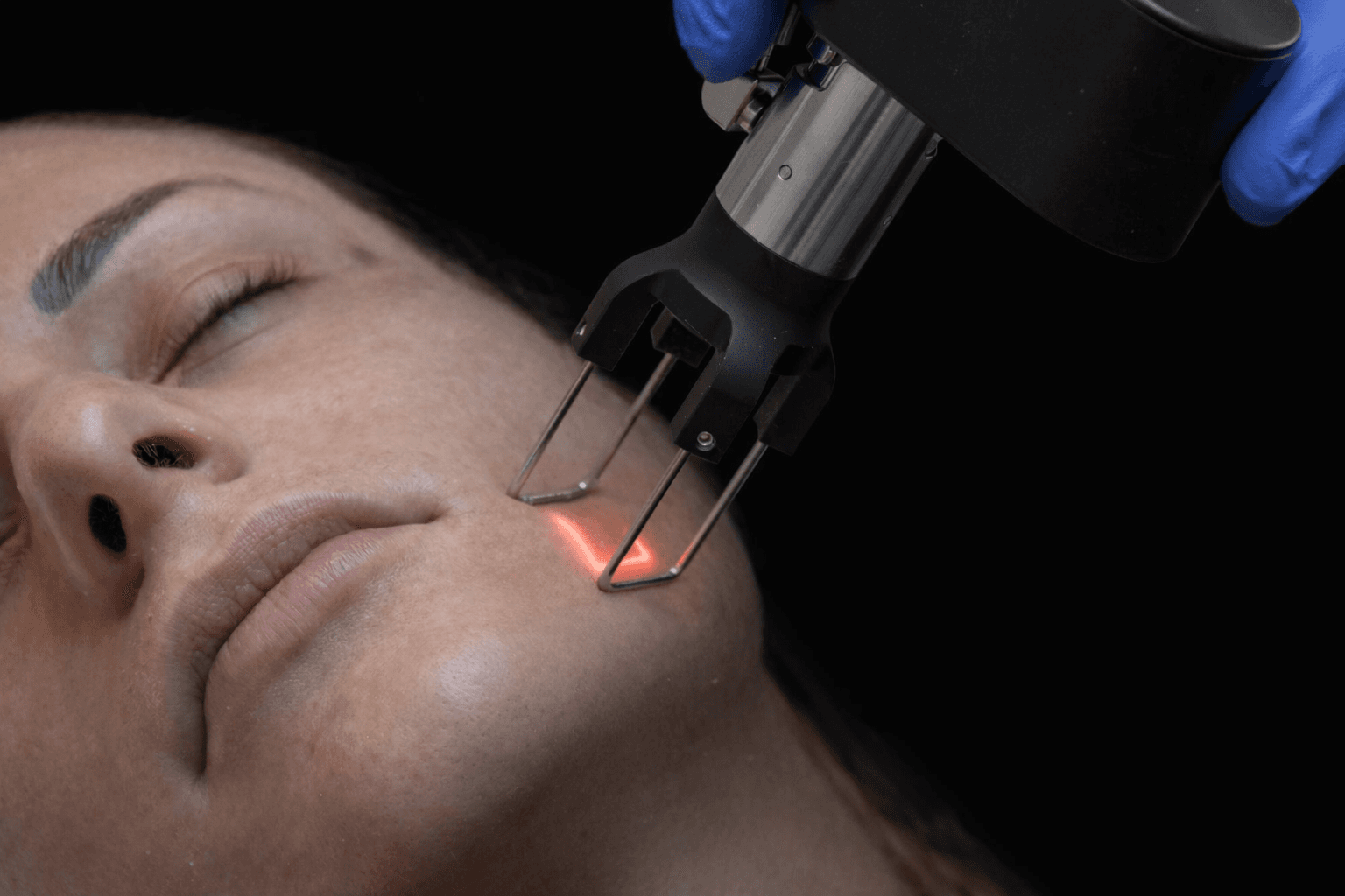 Resurfacing Viso Ablativo